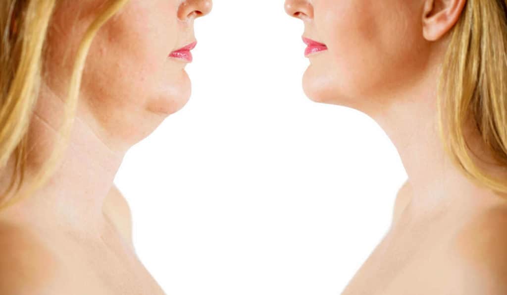 Double Chin treatment Hamilton before and after results