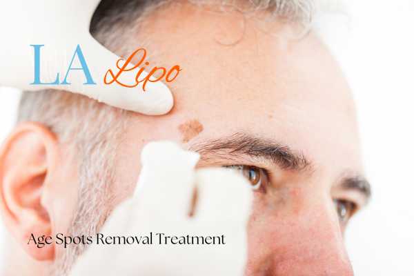 What Are the Most Effective Treatments for Age Spots Hamilton?