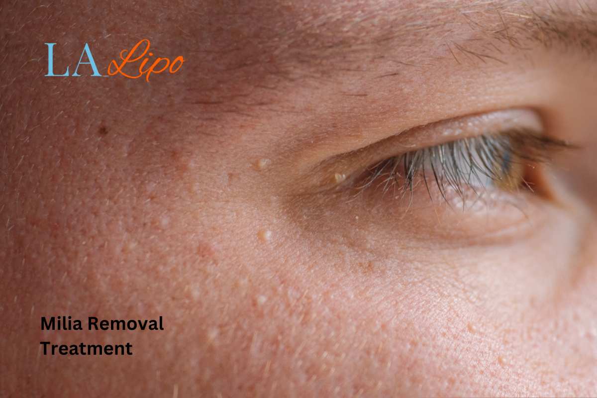 Cryopen Milia Removal: Is It the Easiest and Safest Option Hamilton?