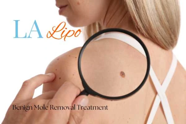 Why getting moles removed Hamilton can boost your confidence!
