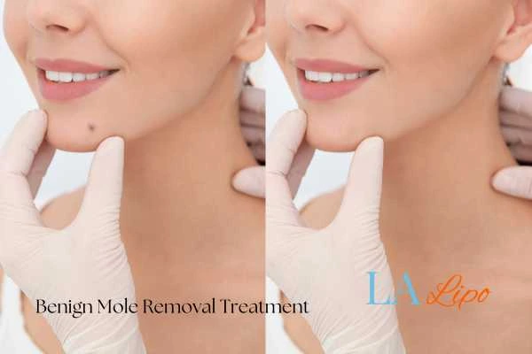 Woman's before and after results of being moles removal treatment Hamilton
