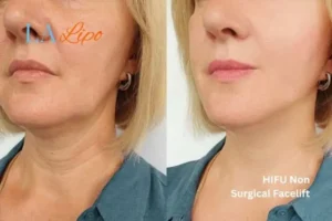 hi-fu for wrinkles Hamilton before and after results