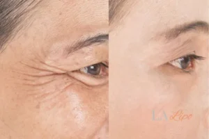 Before and after results of woman - HI-fu wrinkles reduction treatment Hamilton