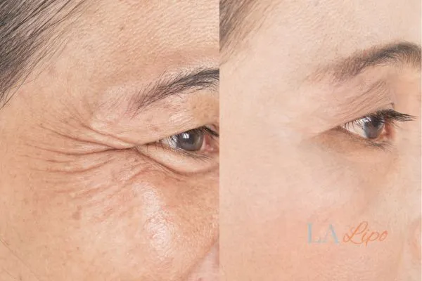 Before and after results of woman - HI-fu wrinkles reduction treatment Hamilton