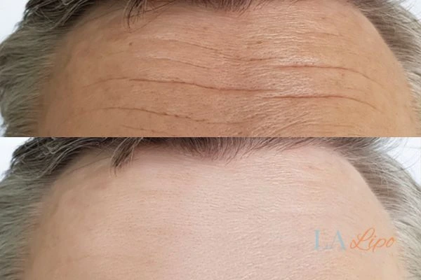 results of HIFU Hamilton on mans forehead to help reduce lines and wrinkles