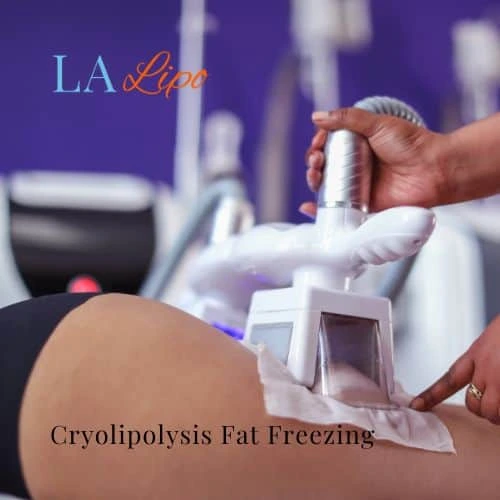 fat freezing - Cryolipolysis Hamilton