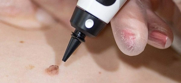 skin tag removal using cryopen Hamilton