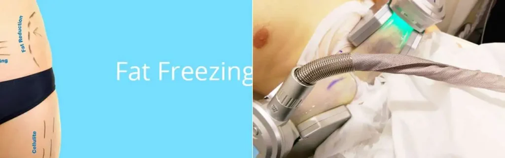 multi areas of a persons body having coolsculpting Hamilton treatment