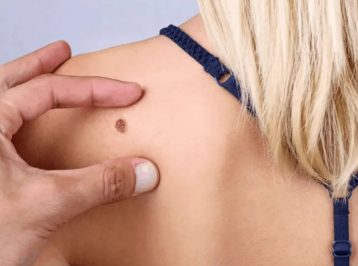 woman having mole removal Hamilton consultation before treatment.