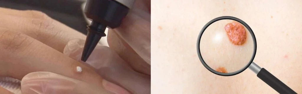 Person getting moles removed with cryopen Hamilton