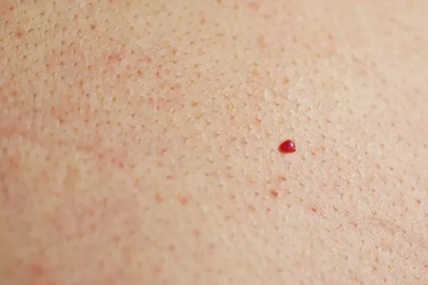 close up of a cherry angioma Hamilton