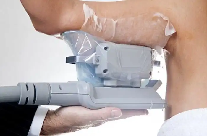 Picture of fat freezing Hamilton on the upper arms.
