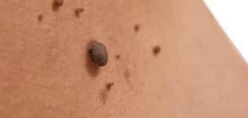 image of a skin tag Hamilton