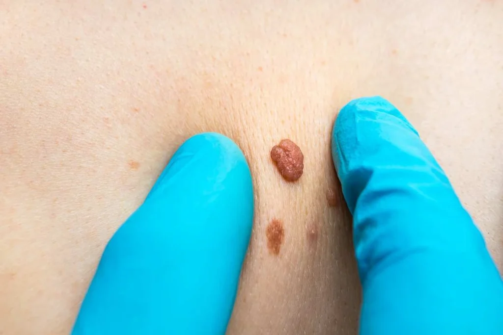 Consultant examining a skin tag Hamilton