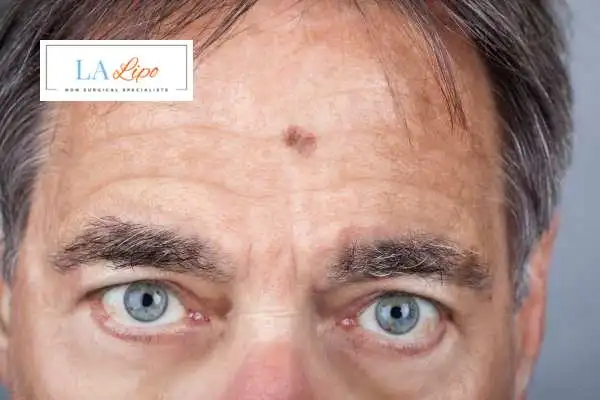 Solar Lentigo Removal Hamilton image of man with mark on his forehead