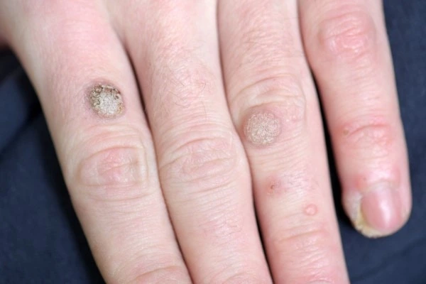 photo of warts on person hand - see wart removal Hamilton from LA LIPO