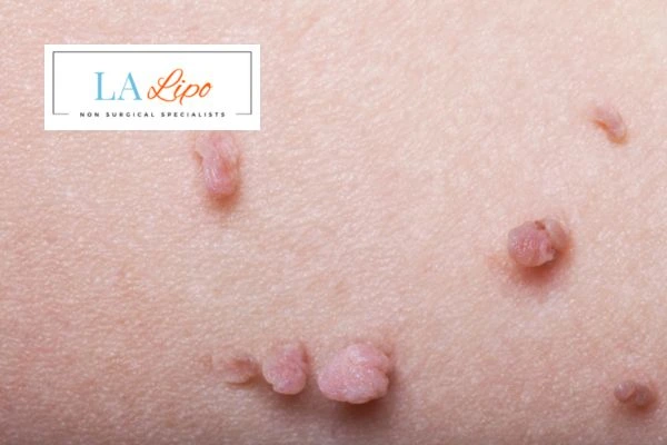 Does cryopen skin tag removal Hamilton hurt? Find out now call our team today!