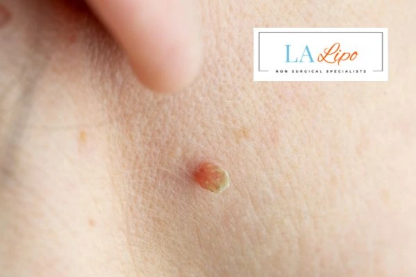 Book skin tag removal Hamilton today speak to our team now!