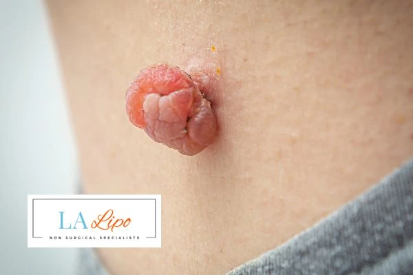 Interested in skin tag removal Hamilton? Concerned about the pain? Find out more today!