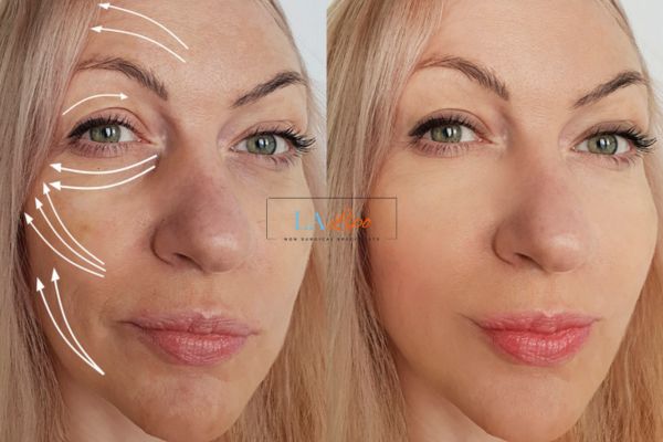 Morpheus 8 results Hamilton face lift.
