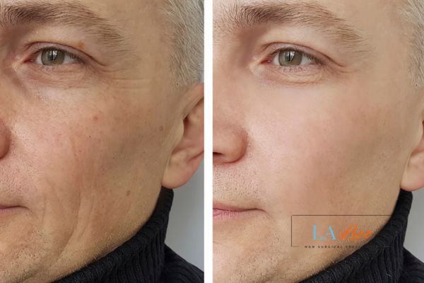 See the amazing results of Morpheus8 Treatment Hamilton!