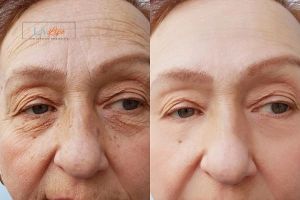 The powerful benefits of Morpheus8 Treatment Hamilton - Call Our team today!