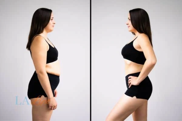 Picture of womans before and after using LA-EMS body sculpting to improve her core strength Hamilton