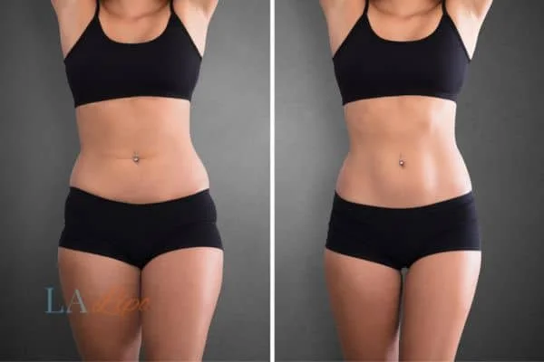 before and after results of non-surgical treatment to help a woman's body image and mental health Hamilton