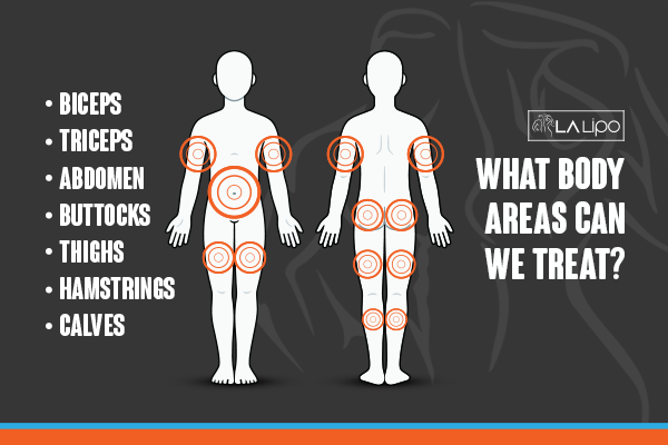 Diagram to show areas you can have LA-EMS Body Sculpting Treatment Hamilton