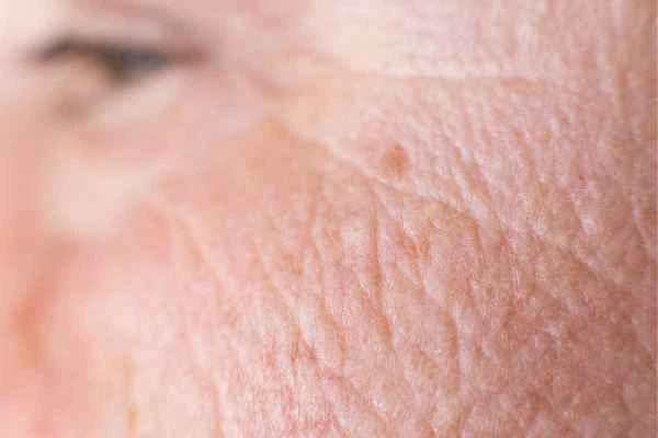 close up picture of a woman's face showing an age spot Hamilton