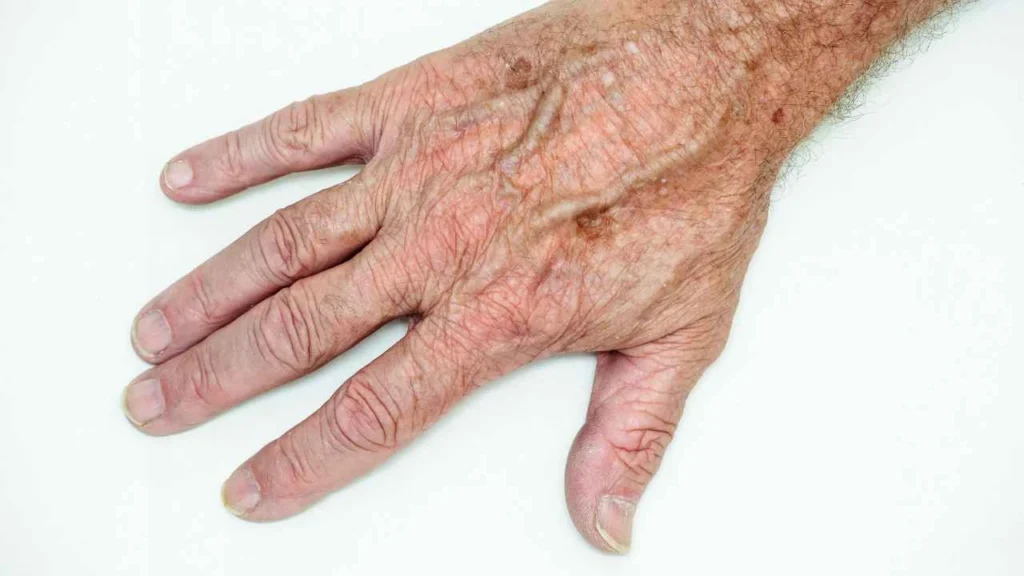 Male hand showing age spot Hamilton