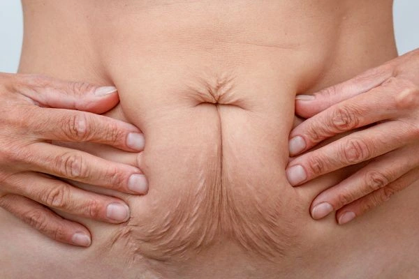 Image of a woman's stomach with loose skin - example of skin tightening Hamilton options
