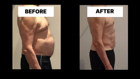 What Symptoms Can Diastasis Recti Cause in Men? Weak Core, Back Pain and Poor Posture Hamilton